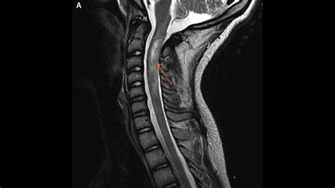 Spinal Cord Lesions - The Neurology Hub