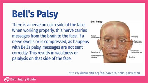 Bell's Palsy Handbook: Facial Nerve Palsy Or Bell's Palsy Facial ...