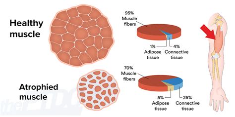 How to Fight Muscle Atrophy After Injury: A Personal Trainer’s Guide