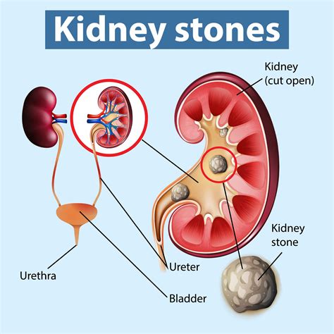 Kidney Stones - Dr Brojen Barman