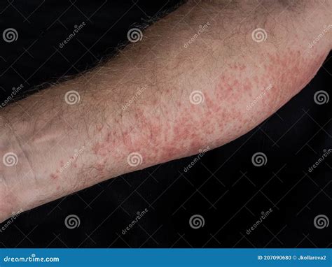 Symptoms of Contact Allergy on Male Hand. Close Up of Hives Stock Photo ...