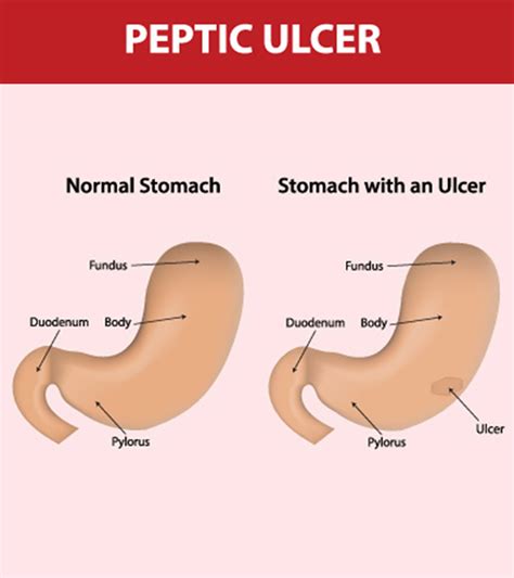 7 Symptoms Of Stomach Ulcer In Children And Its Treatment