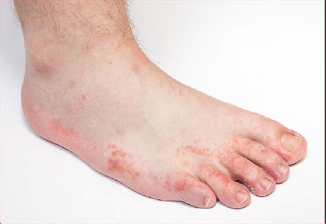 Fungus Foot: Symptoms, Prevention And Those At Risk - Greener Health