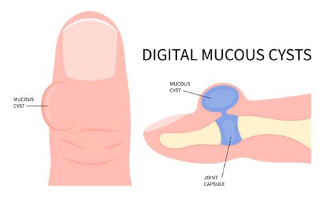 How To Treat a Digital Mucous Cyst on Your Toe - Foot and Ankle Group