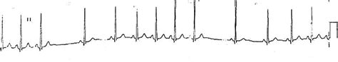 Sinoatrial Exit Block • LITFL • ECG Library Diagnosis