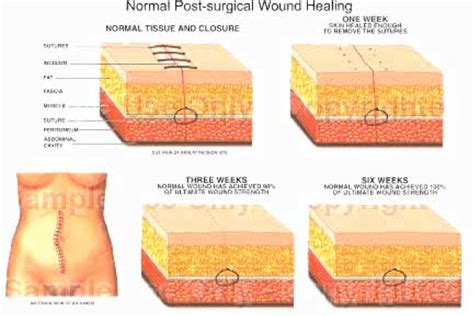 Acute Wounds - Advanced Oxygen Therapy Inc.