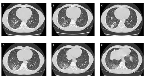 Chest CT scan at presentation (Panel (A-F)). | Download Scientific Diagram