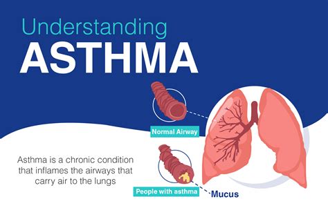 Asthma Pathophysiology Symptoms Causes Treatment – NBKomputer