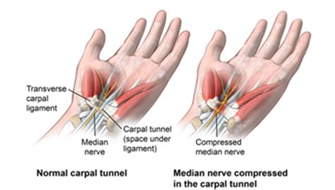 Carpal Tunnel Syndrome | Johns Hopkins Medicine