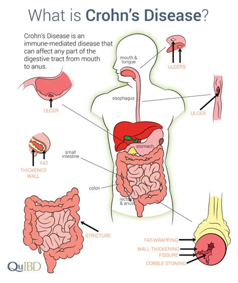 Crohn's Disease IBD Symptoms Advances Impact Causes