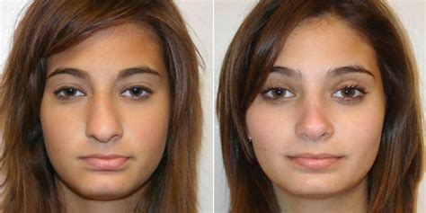 Rhinoplasty and a Deviated Septum - Deviated Septum Information & Advice