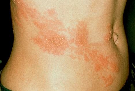 Shingles Contagious | Is Shingles Contagious | Shingles Pictures ...