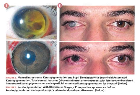 Cosmetic Surgery of the Cornea: A new type of Surgery - Blue Green Medical