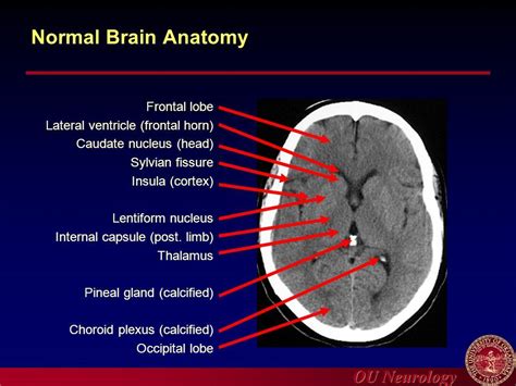 Normal Brain Ct Anatomy