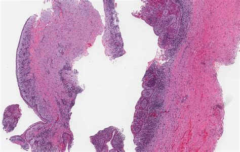 Radicular Cyst Histology