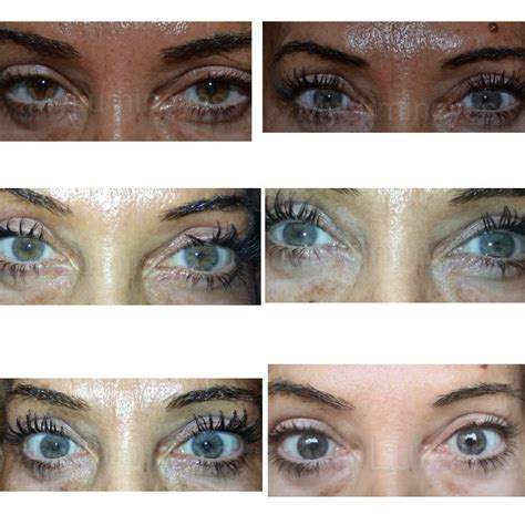 Before And After Photos Of Laser Eye Color Change Surgery