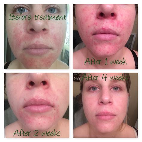 [B&A] I cured facial sebhorreic dermatitis using a raw honey mask! : r ...