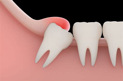 Reasons To Get Wisdom Teeth Removal | South Gables Dental