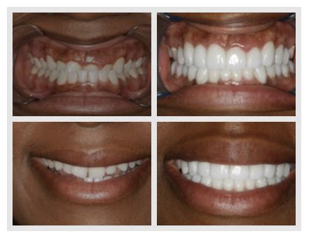 Good Veneers Vs Bad Veneers