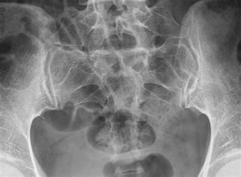 Fractured Sacrum - Fracture Treatment