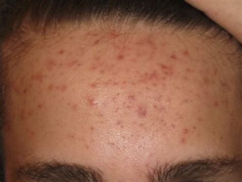 Forehead Acne Causes And Treatments | MDacne