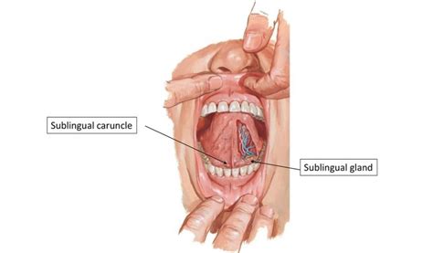 Sublingual Caruncle | News | Dentagama