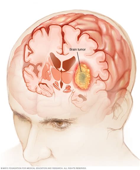 Brain tumor - Symptoms and causes - Mayo Clinic