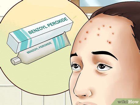 4 Ways to Get Rid of Forehead Acne - wikiHow