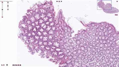 Sessile Polyp Histology