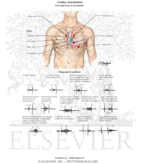 Cardiac Auscultation: Precordial Areas of Auscultation