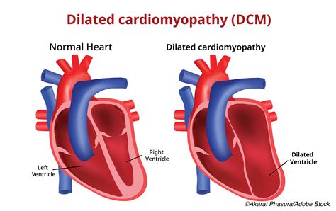 Genetic Profile Refines Risk of SCD in Patients with Left Ventricular Systolic Dysfunction ...