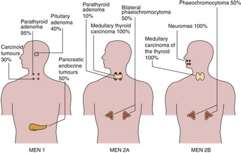 Multiple endocrine neoplasia | Basicmedical Key