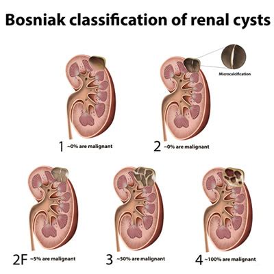 Kidney Cyst Ultrasound And Biopsy Procedure