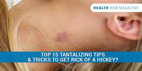 How to Get Rid of a Hickey as Fast as Possible?