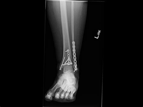 Ortho Dx: Chronic Ankle Pain Following Surgery - Clinical Advisor