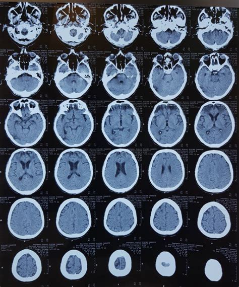 Figure No. 3 -Brain CT scan The results of the chest CT scan (Fig. No ...