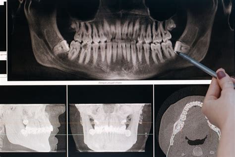 The Health of Your Teeth & the Surprising Connection to Bone Health ...