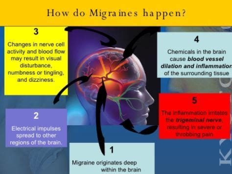 Ocular Migraine - Symptoms, Causes, What is?, Treatment, Images