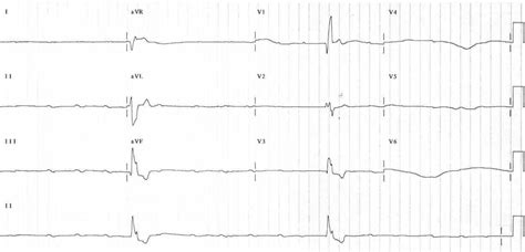 Ventricular Escape Rhythm • LITFL • ECG Library Diagnosis