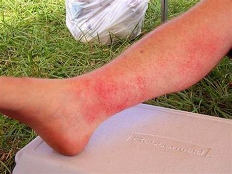 👉 Sun Poisoning - Pictures, Symptoms, Causes, Treatment (February 2022)