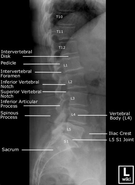 Lumbar Vertebrae Anatomy Lateral