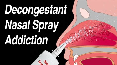 Decongestant Nasal Spray Addiction (Afrin, Zicam, Sinex, Neo-Synephrine, etc) - YouTube