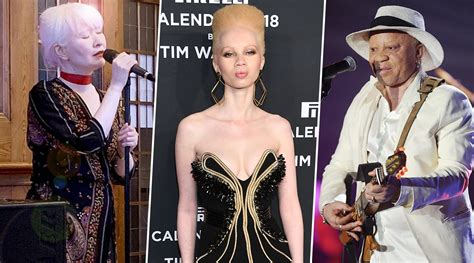 Lifestyle News | International Albinism Awareness Day 2020: Famous Albino Personalities Who Made ...