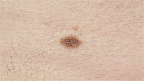 Melanoma symptoms: How to spot signs, and when to see a doctor