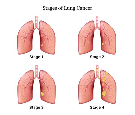 Stage 2 Of Lung Cancer