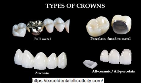 Types of Dental Crown - #1 Dental Office in California 94560, 95133