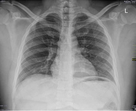 Chest X-ray PA view; normal chest X-ray. | Download Scientific Diagram