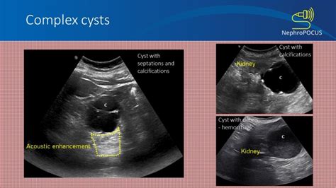 Renal cyst: simple or complex? – NephroPOCUS