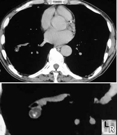 LearningRadiology - Hamartoma, Lung