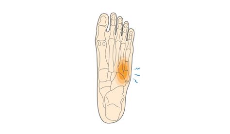 Tuberosity Of 5th Metatarsal Pain